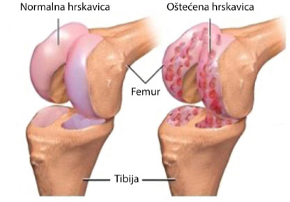 bol sa strane zgloba koljena s unutarnje strane)